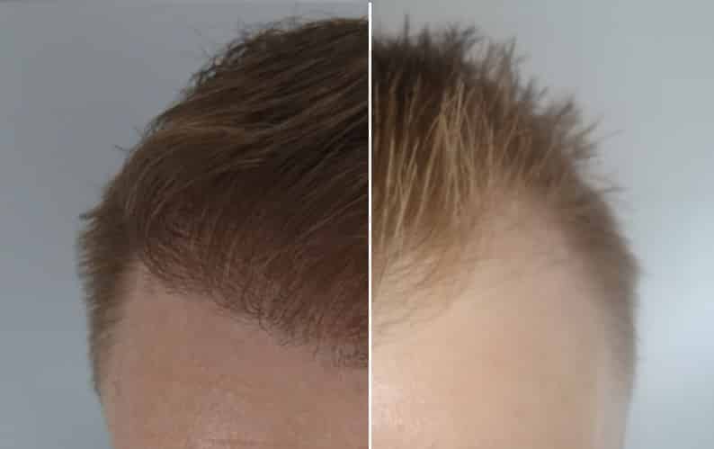 Image of a hair transplant before and the results after a hair tranpslantation.